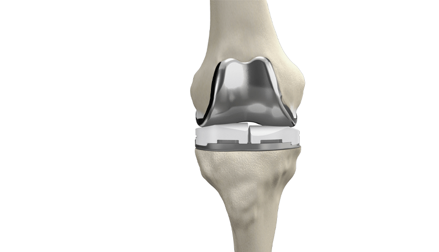 Norme de test ASTM F2083-12 pour les prothèses de remplacement du genou