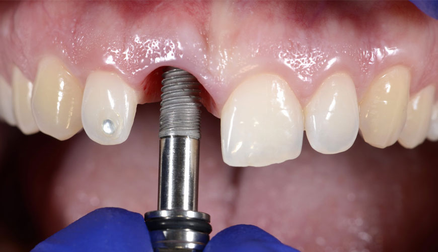 Prueba EN ISO 16061 para instrumentos utilizados en implantes quirúrgicos inactivos