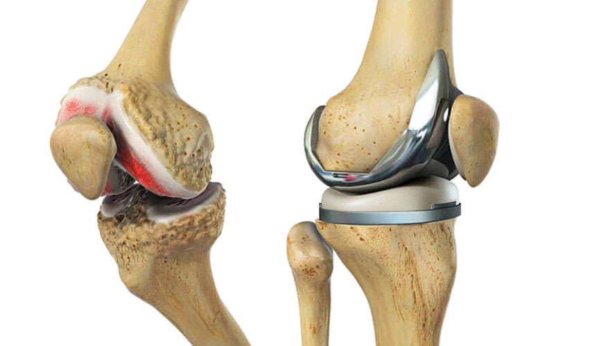 EN ISO 21536 Requisitos especiales para implantes quirúrgicos inactivos, implantes de reemplazo de articulaciones, implantes de reemplazo de articulaciones de rodilla