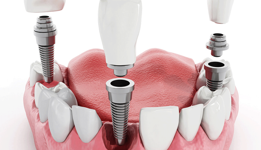 ISO 14801 Стоматология - Имплантаты - Стандарт испытаний на динамическую нагрузку для внутрикостных зубных имплантатов