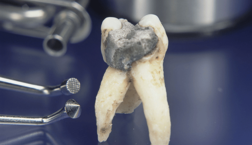 ISO 24234 Dentistry Test Standard for Dental Amalgam