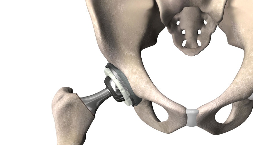 ISO 7206-1 Implantes quirúrgicos, prótesis parciales y totales de la articulación de la cadera, Parte 1: Prueba estándar para clasificación y determinación de tamaños